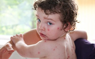 3 lucruri pe care trebuie să le știi despre varicelă